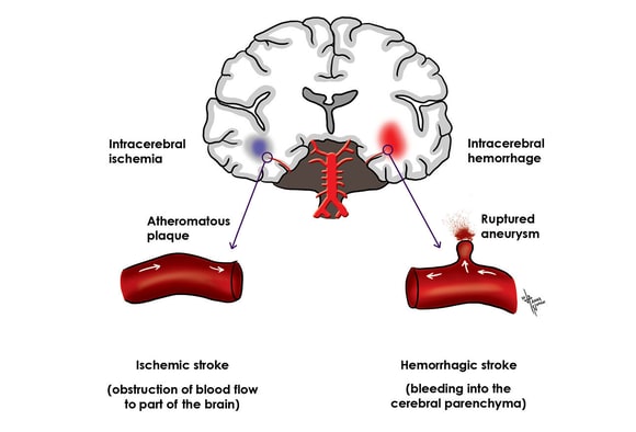What is a Cerebrovascular Accident Types Symptoms How To Cure Details Explained!
